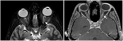 Central Nervous System Involvement in Common Variable Immunodeficiency: A Case of Acute Unilateral Optic Neuritis in a 26-Year-Old Italian Patient